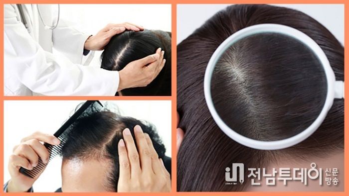 반영구 ‘두피문신’