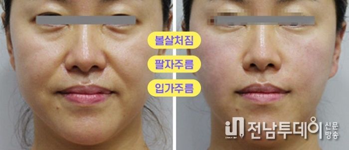자가 진피재생술